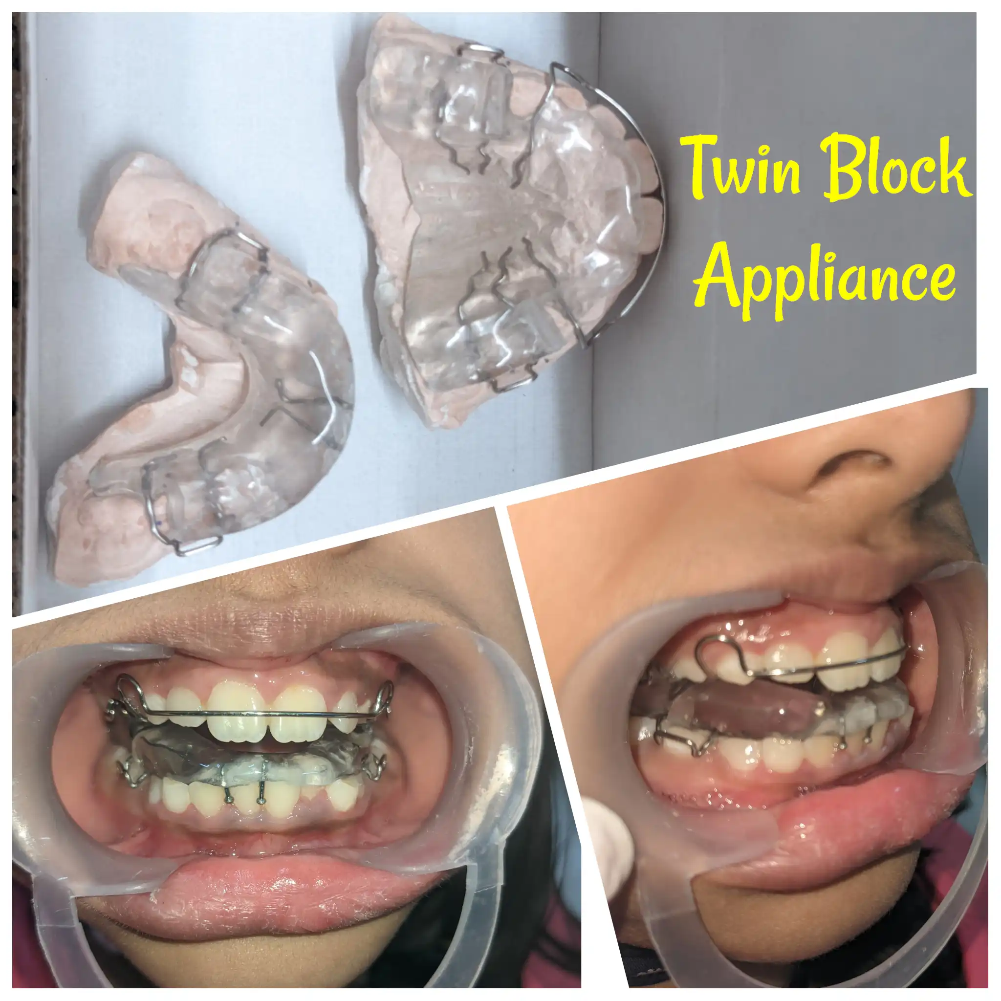 Braces Treatment in Delhi Cusp Dental