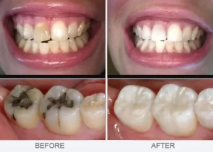 Improved Appearance of Teeth